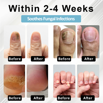 ATTDX® MycoStop Nail Recovery Serum Pen