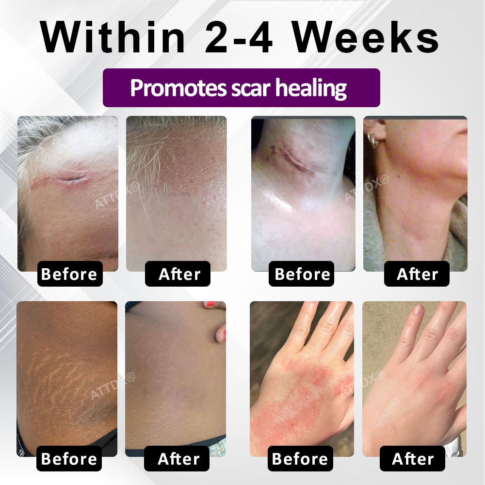 ATTDX® NanoHeal Advanced Face & Body Scar Gel