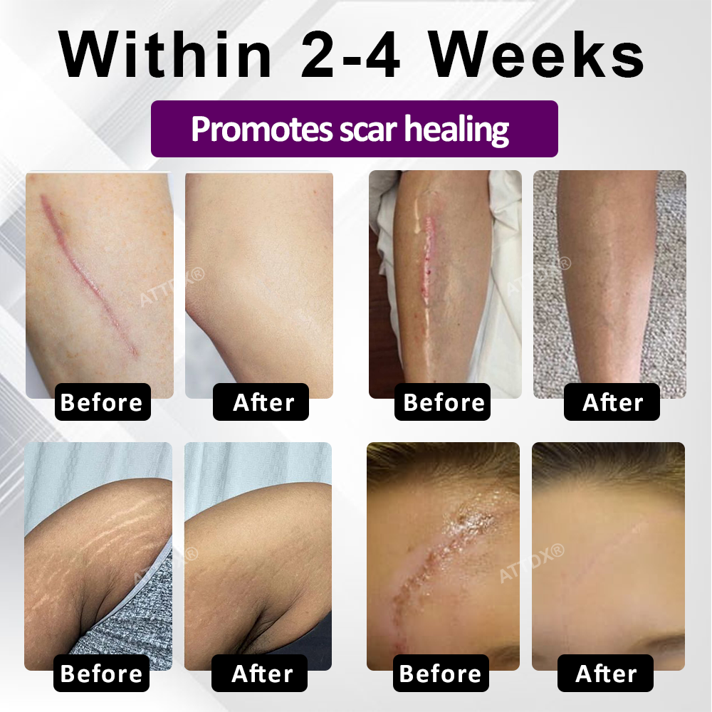 ATTDX® NanoHeal Advanced Face & Body Scar Gel