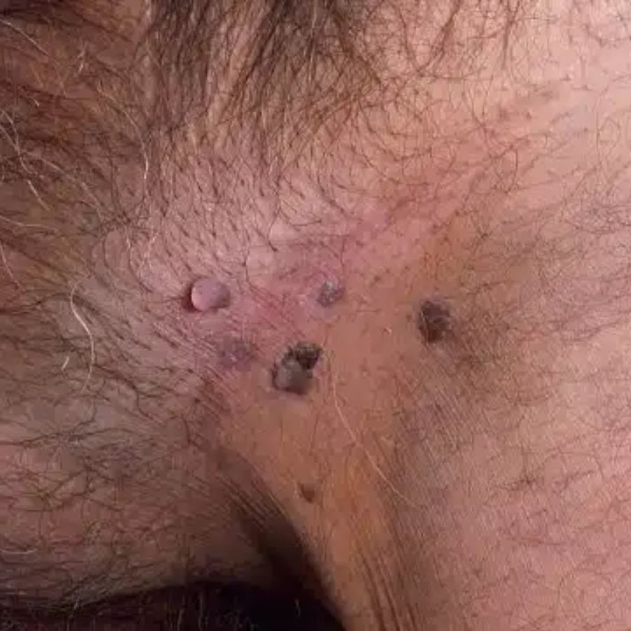 ATTDX® NanoLipo HPV Genital Warts Eraser Cream 25 ATTDX® NanoLipo HPV Genital Warts Eraser Cream