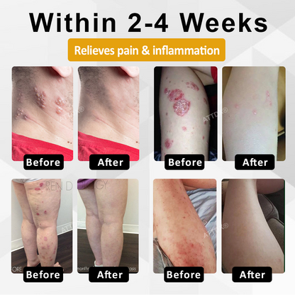 ATTDX® NervoSoothe Shingles Healing Ointment