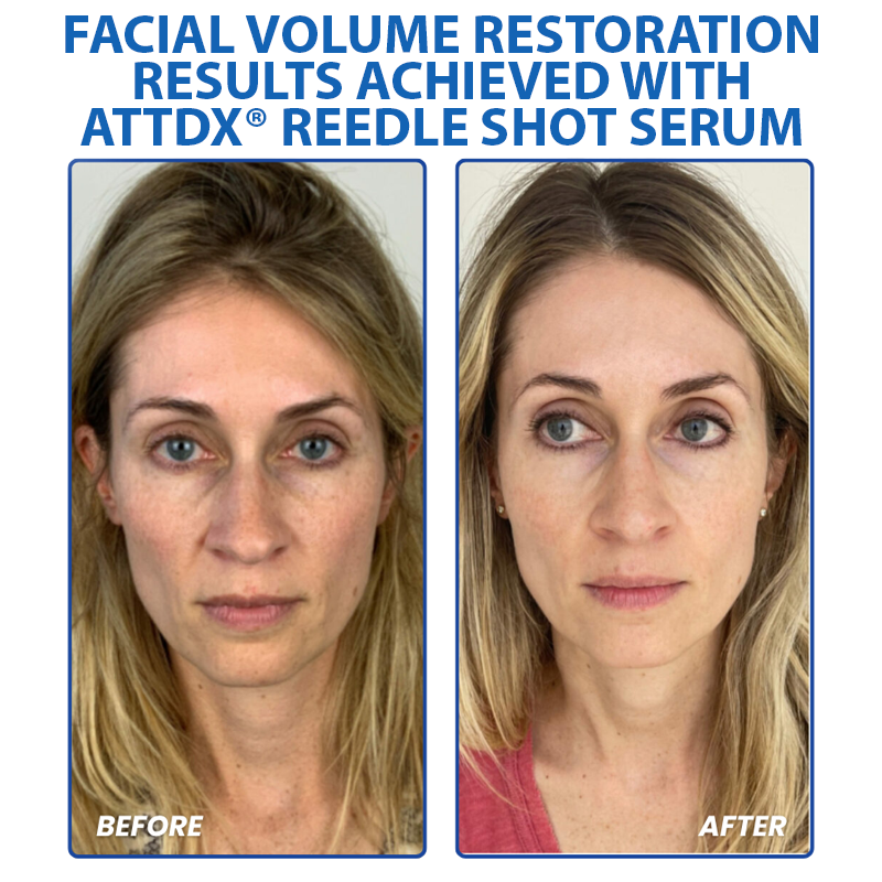 ATTDX® PDRN-NAD+ Cica Reedle Shot Serum 21 ATTDX PDRN NAD Cica Reedle Shot Serum Abi04