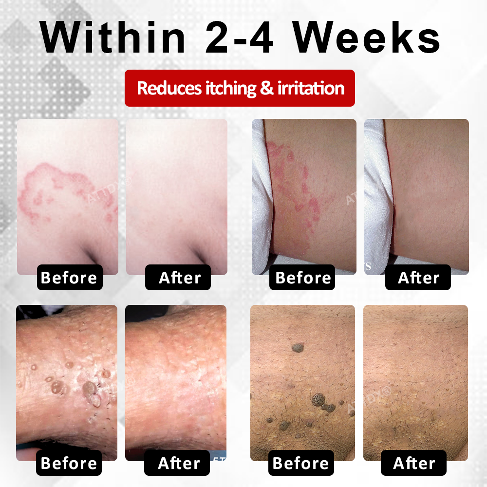 ATTDX® PowerRelief Men’s HPV Care Spray