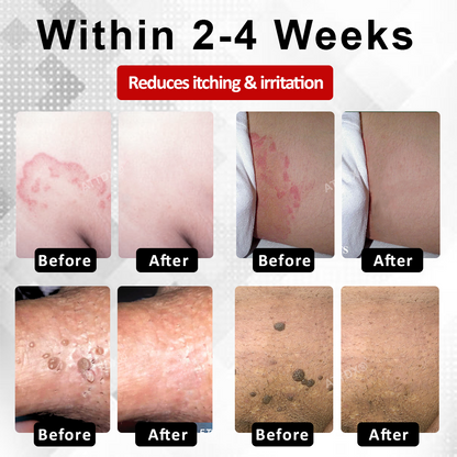 ATTDX® PowerRelief Men’s HPV Care Spray