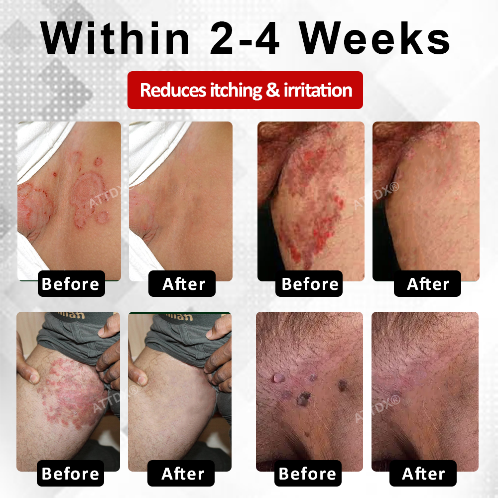 ATTDX® PowerRelief Men’s HPV Care Spray