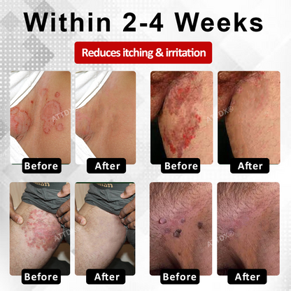 ATTDX® PowerRelief Men’s HPV Care Spray