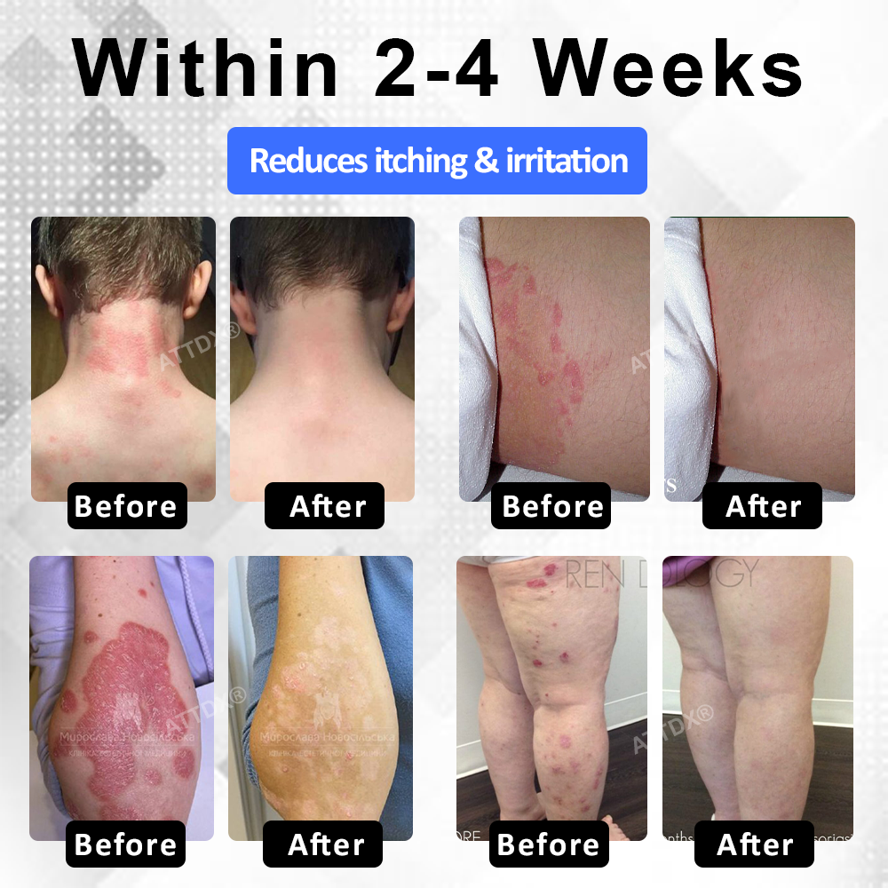 ATTDX® PsoriEase Magnesium Healing Foam