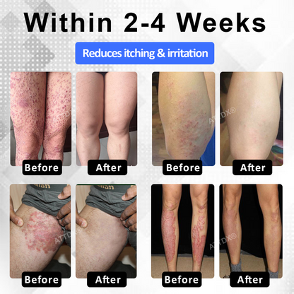 ATTDX® PsoriEase Magnesium Healing Foam