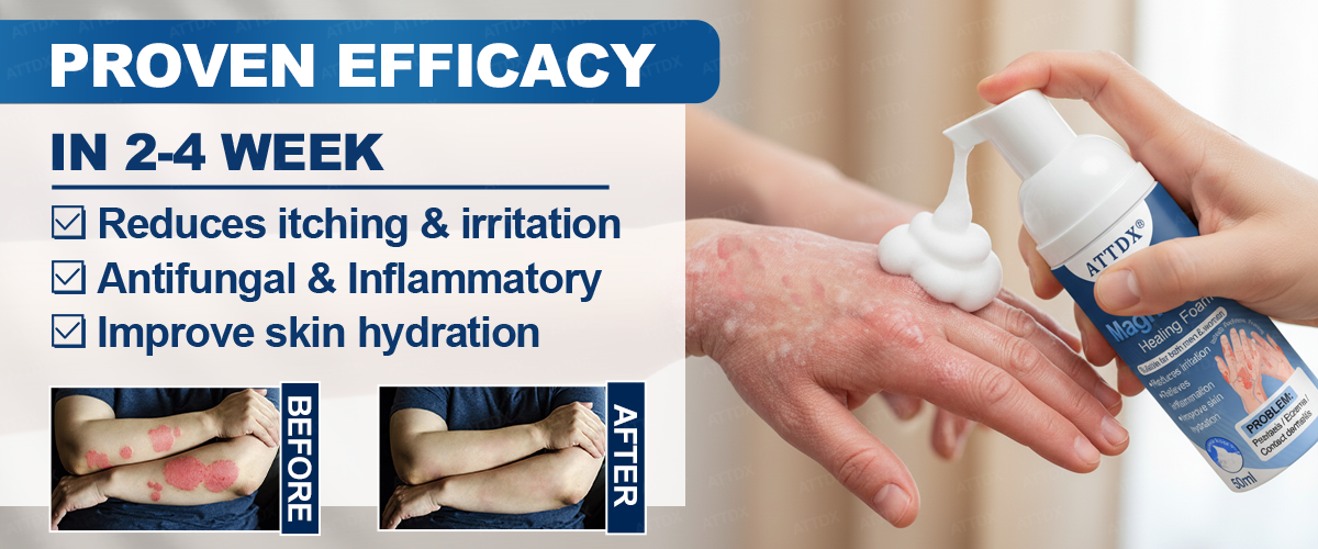 ATTDX® PsoriEase Magnesium Healing Foam 26 ATTDX PsoriEase Magnesium Healing Foam12