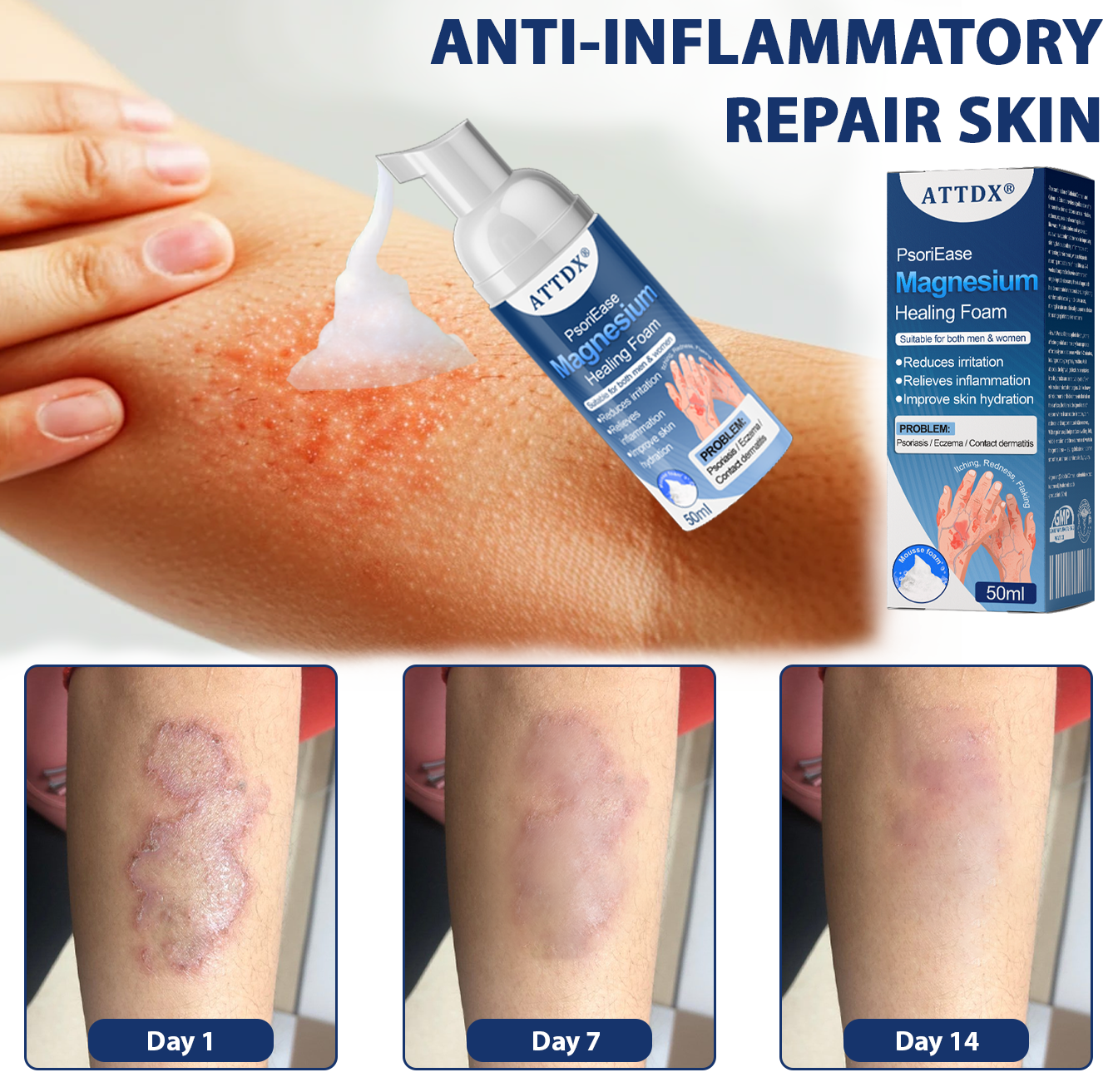 ATTDX® PsoriEase Magnesium Healing Foam 28 ATTDX PsoriEase Magnesium Healing Foam abi17 1