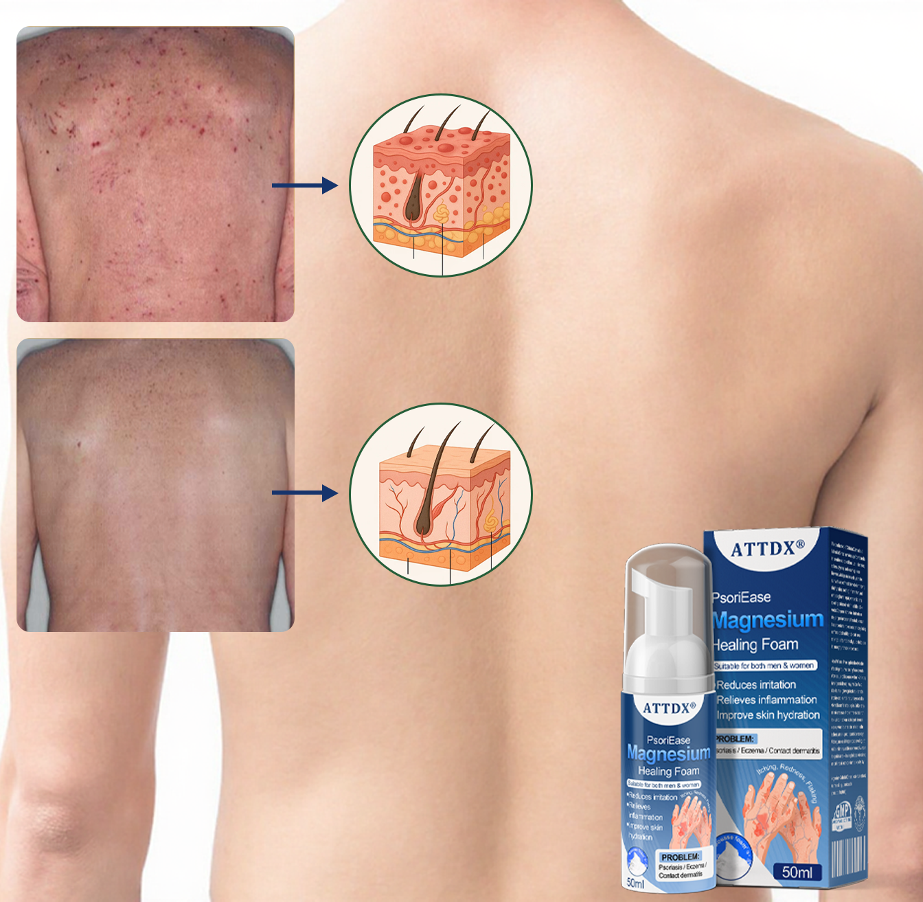 ATTDX® PsoriEase Magnesium Healing Foam