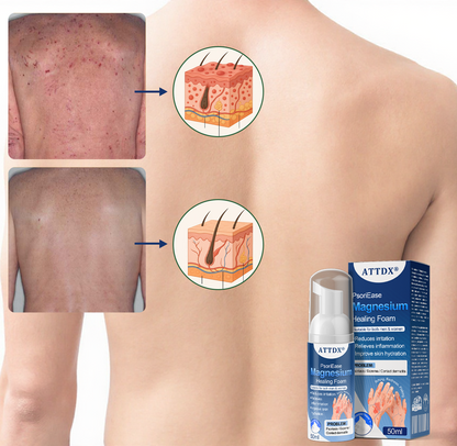 ATTDX® PsoriEase Magnesium Healing Foam