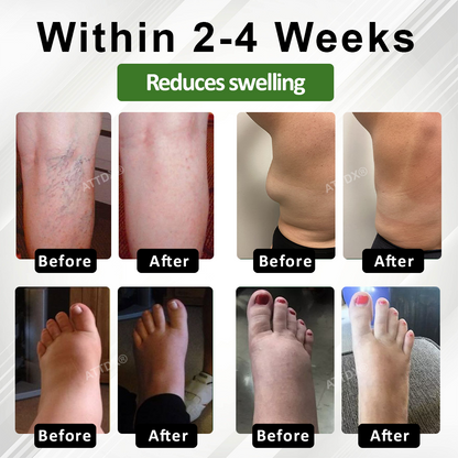 ATTDX® SpiculeFlow Advanced Edema Drainage Cream