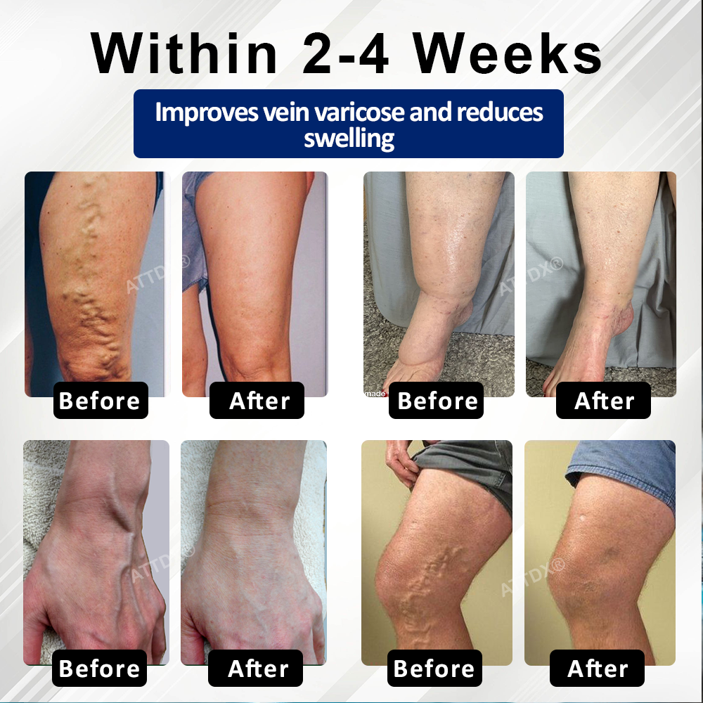 ATTDX® VeinFocus Microneedle Leg Patch