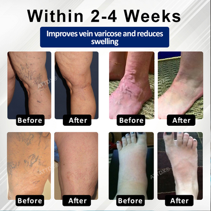 ATTDX® VeinFocus Microneedle Leg Patch