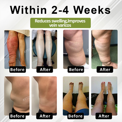 ATTDX® VeinoRoll Therapy Edema Comfort Cream