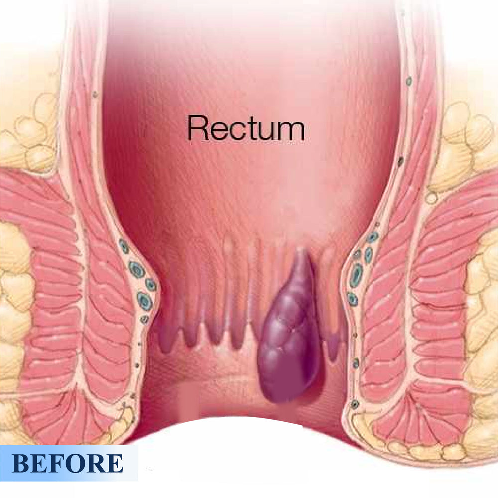 ATTDX® Medical Hemorrhoid Herbal Gel with Applicator 24 ATTDX® Medical Hemorrhoid Herbal Gel with Applicator