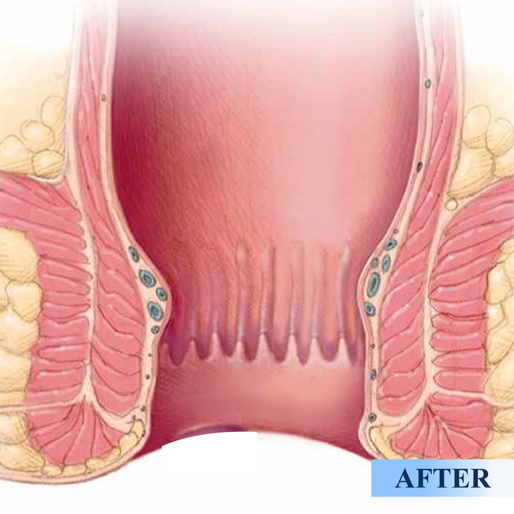 ATTDX® Medical Hemorrhoid Herbal Gel with Applicator 25 ATTDX® Medical Hemorrhoid Herbal Gel with Applicator