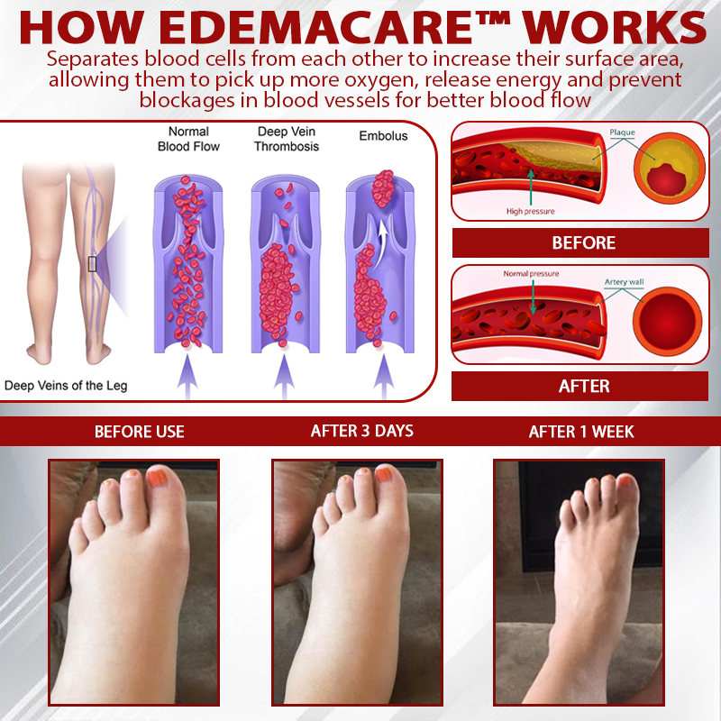 EdemaCare™ LymphDrain Horse Chestnut Massage Cream