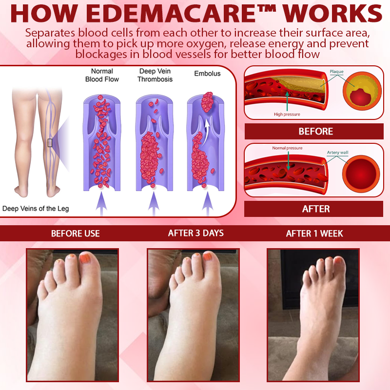 EdemaCare™ VenoLymph Massage Therapy Cream