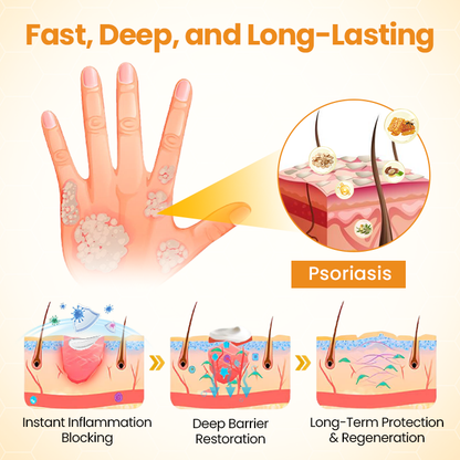 ATTDX® BeeSooth Psoriasis Skin Care Cream