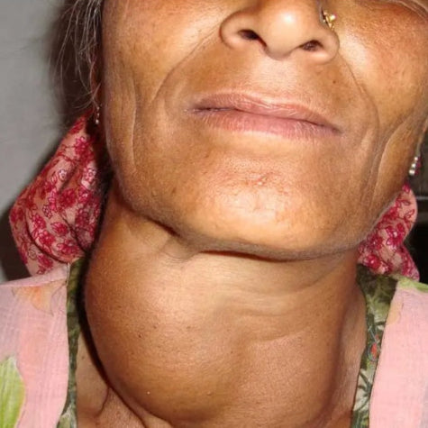 lymph neck step2